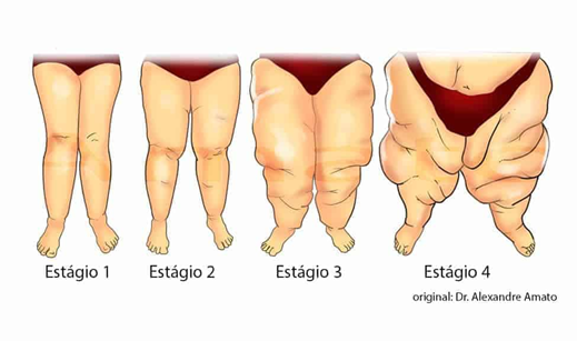 Estágios do lipedema