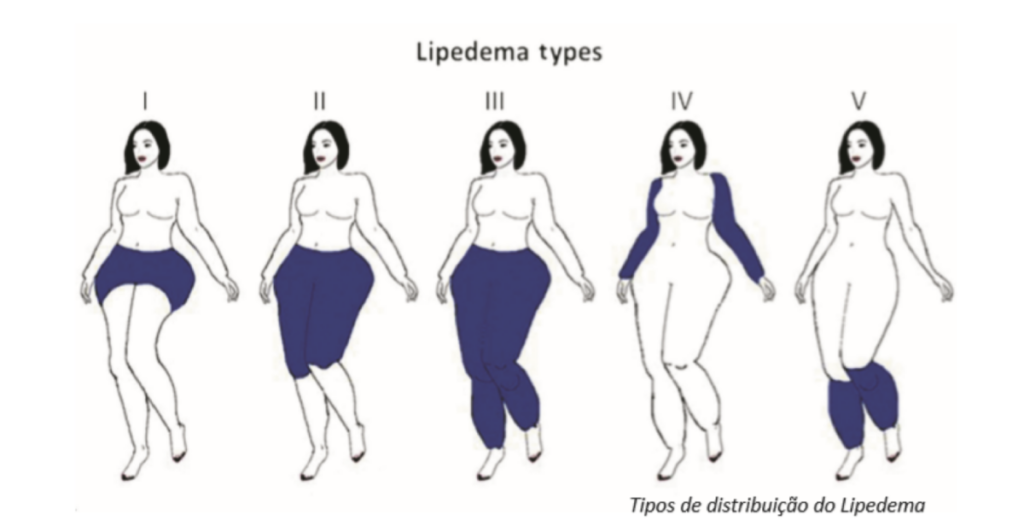 Tipos de Lipedema